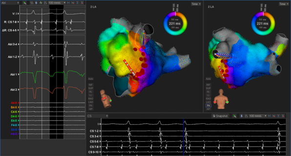 Cartographie électrophysiologique 3D du cœur avec le système RYTHMIA HDx